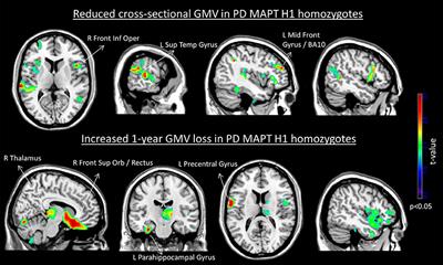 Early Gray Matter Volume Loss in MAPT H1H1 de Novo PD Patients: A Possible Association With Cognitive Decline